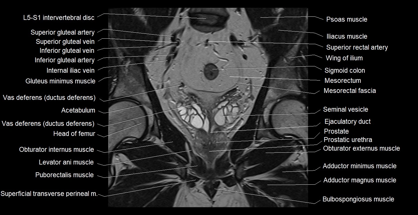 MRI coronal cross sectional anatomy male pelvis image 22.webp